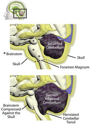 Cerebellar Infarct