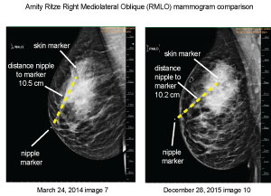 RMLO mamogram comparison