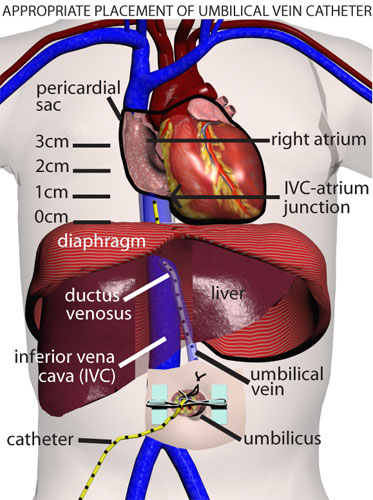 Umbilical Vein Catheter