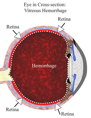 VITREOUS-HEMORRHAGE