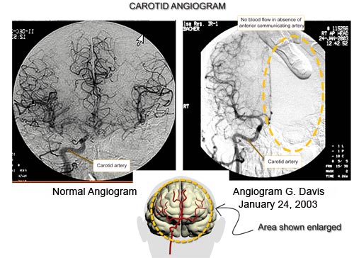 carotid angiogram