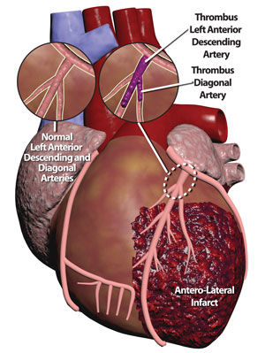 coronary-disease-myocardial infarctinfarct