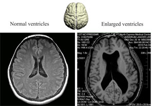 enlarged brain  ventricles