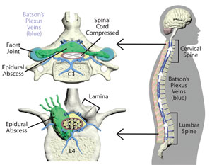 epidural abscess