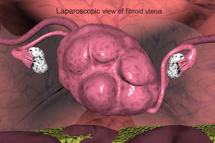 uterine fibroid