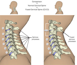 cervical spine fusion