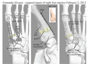 lis franc fracture