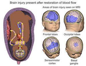neonatal brain injury