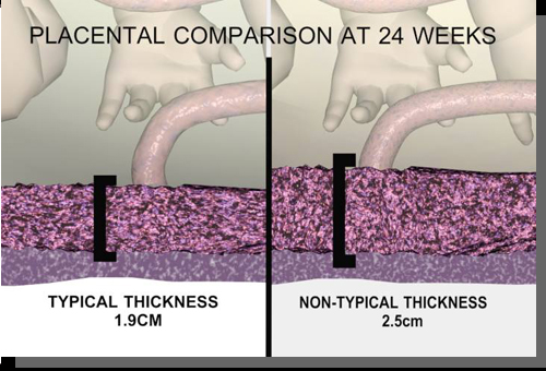 placenta thickness