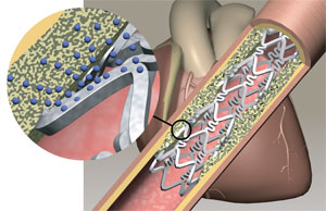 drug eluting coronary artery stent