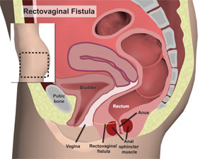 rectovaginal fistula