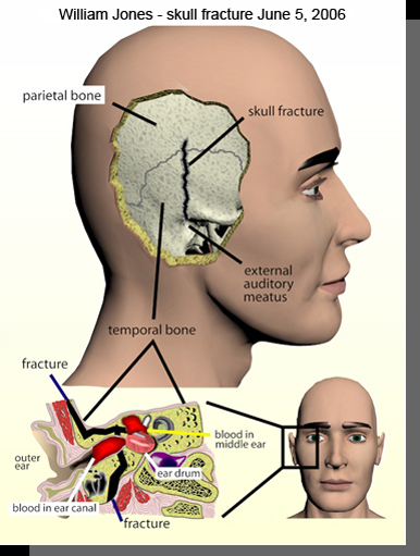 skull_fracture