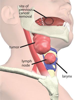 Glossal Tumor