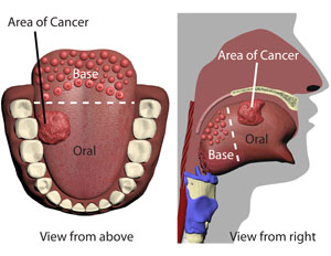 tongue cancer